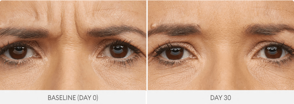 Forehead wrinkles before and after anti-wrinkle injections