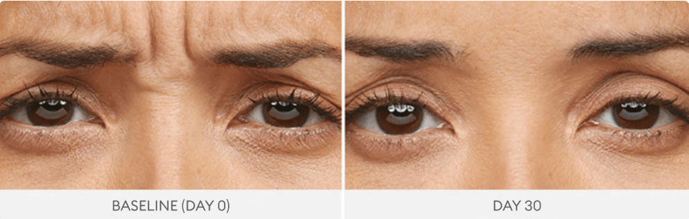 Anti-wrinkle injections before and after